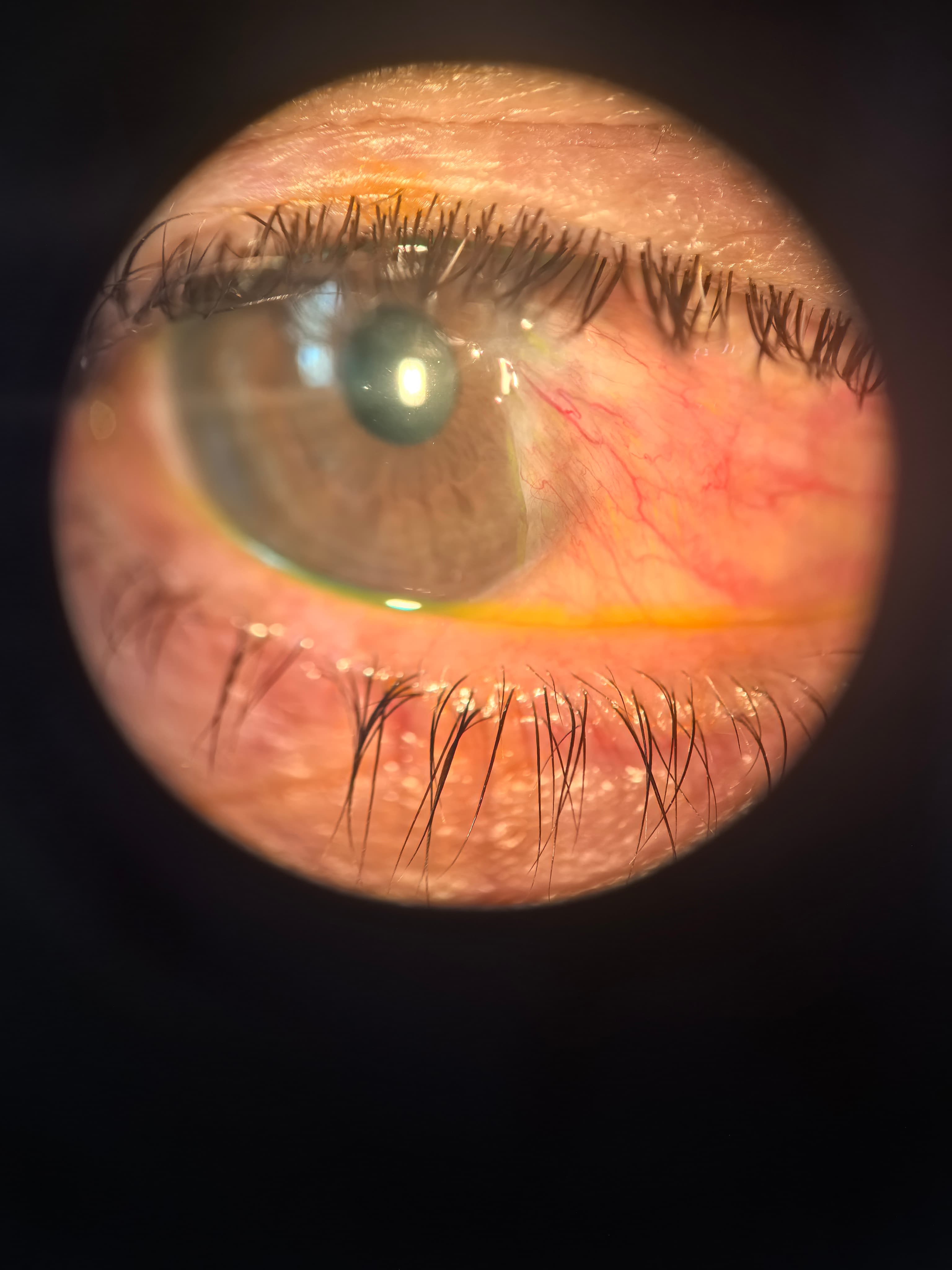 Pterigión o carnosidad en el ojo visto en lámpara de hendidura