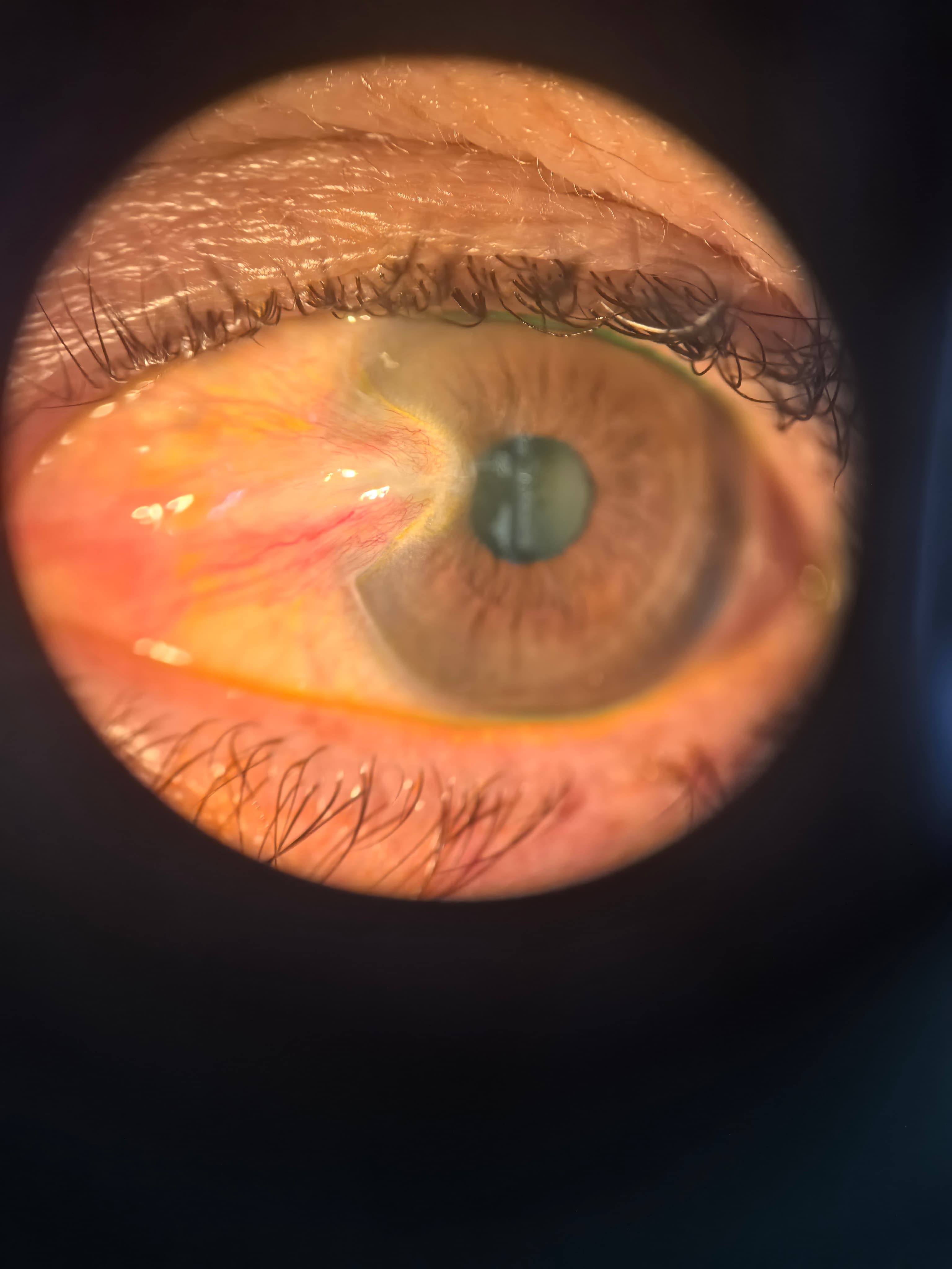 Pterigión o carnosidad en el ojo — crecimiento fibrovascular sobre la córnea